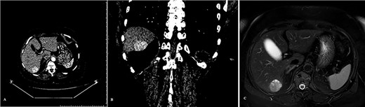 Tumor of the liver detected on the pre-operative diagnostics: (A) CT scan arterial phase frontal projection, (B) CT scan arterial phase frontal projection and (C) MRI scan, axial projection.