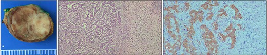 The specimen after surgery: (A) the view of the tumor and (B, C) microphotograph images of the tumor.