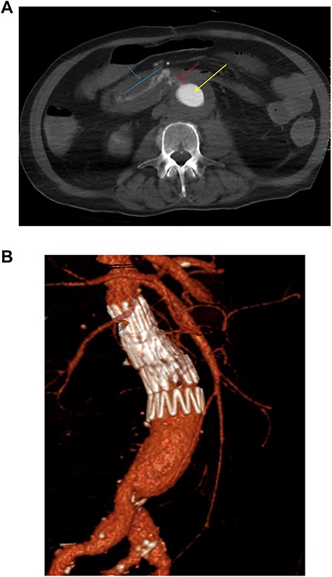 (a) Axial thick slice of a CT with IV contrast in the arterial phase shows the lumen of the surgical graft (yellow arrow), clear contrast opacification within the fistula (red line and arrow) and the duodenum (blue line and arrow) consistent with active haemorrhage; (b) sagittal reconstruction of a CT with IV contrast in the arterial phase showing the overlapping aortic stent grafts inserted to exclude the AEF from the circulation.