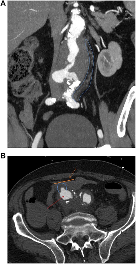(a) Preoperative coronal thick slice of a CT with IV contrast in the arterial phase shows aneurysmal aorta with normal calibre common iliac arteries; however, inflammatory change around the aortic aneurysm is seen extending into the proximal iliac bifurcation (blue outline); (b) axial slice of a CT with IV contrast in the arterial phase shows aneurysmal common iliac arteries (red arrow), a clear saccular bulge (blue outline) into an adhered loop of small bowel (orange outline and arrow); the site of the fistulation.