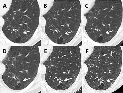 Transition of CT images. Arrows show the tumor. (A) 12 years before surgery. A small ground grass nodule (GGN) adjacent to the cyst wall was identified in the left lower lobe. (B) 9 years before surgery. (C) 6 years before surgery. The GGN showed enlargement. (D) 4 years before surgery. The GGN transformed to the solid lesion gradually. (E) 2 years before surgery. The small intralesional cavities were identified in the nodule. (F) The CT image taken just before surgery.