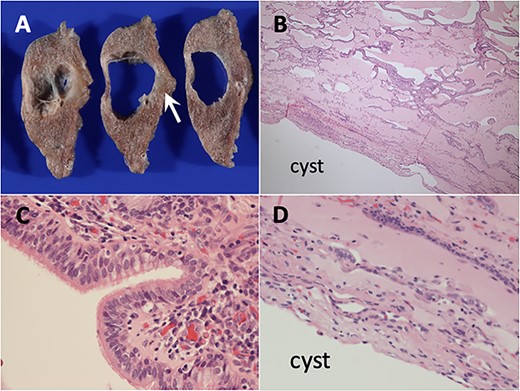 Histopathological findings of ciliated muconodular papillary tumor. (A) Unclearly circumscribed grey–white tumor measuring 10 mm in diameter along the cyst (arrows). (B) Low-magnification view showed peribronchiolar architecture with the alveolar cavities filled with abundant mucus (hematoxylin and eosin stain). (C) High-magnification view showed the tumor constructed of ciliated columnar, mucous and basal cells. (D) The cyst wall did not have any abnormal findings.