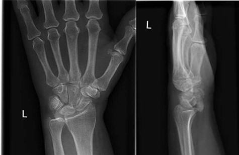 AP and lateral radiographs of the left wrist on initial presentation to the emergency department, showing amorphous calcification overlying the lunate.