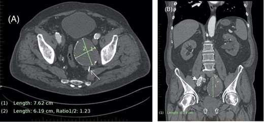 (A) Axial CT demonstrating left internal iliac aneurysm (IIAA) measuring ×76 62 mm with retrograde flow into the aneurysm (arrow) from the deep pelvic vessels. (B) Coronal CT demonstrating the left IIA with a craniocaudal length of 83 mm. The right external iliac artery endograft limb is also visible (arrowhead).