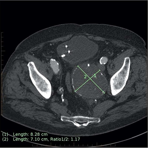Axial CT image on 6-month follow-up demonstrating expansion of the IIAA by 7 mm, now measuring 83 × 71 mm axially (previously 76 × 62 mm).