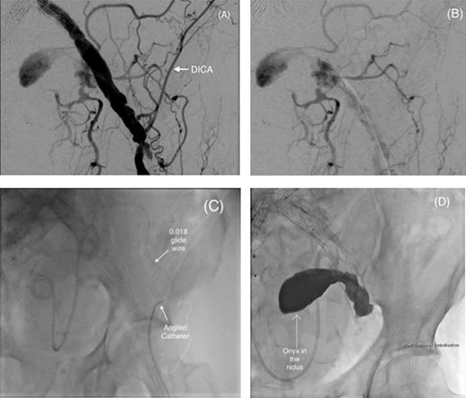 (A and B) Pre-embolization digital subtraction angiography (DSA) via a retrograde ipsilateral common femoral artery puncture demonstrating the left IIAA with inflow from the deep pelvic arteries including the DICA. (C) Microcatheter utilization to cannulate the aneurysm nidus with an angled catheter over an 0.018 hydrophilic Glidewire® to access the DICA. (D) Onyx™ successfully injected into the IIAA nidus.