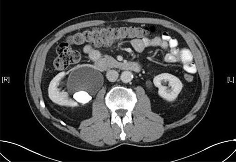 CT scan showing a staghorn calculus in the right renal pelvis with associated hydronephrosis.