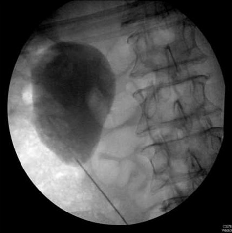 Retrograde pyeloureterogram confirming position of right ureteric stent.