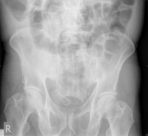 Post-operative plain abdominal X-ray demonstrating acceptable right ureteric stent position.