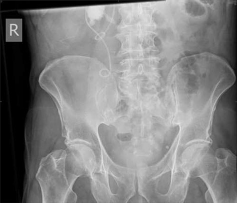 Plain abdominal X-ray performed at follow-up demonstrating proximal ureteric stent migration.