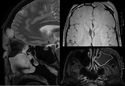 Sagittal and transverse of MRI Pott’s puffy tumour
