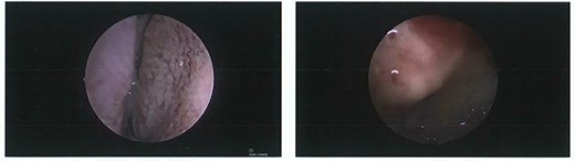 Intraoperative photos. Left: view of dura on endoscopic examination of frontal sinus via bony erosion. Right: complete bony occlusion of frontal recess