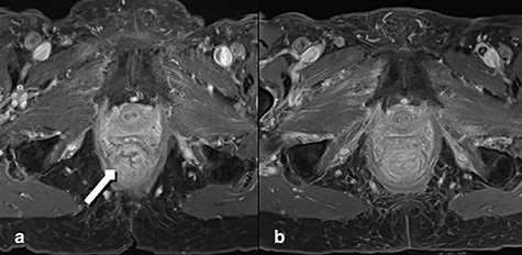 MRT Imaging little pelvis. (a) Before radiotherapy. Tumor appears in the lower rectum with suspicion of muscle infiltration (long arrow). (b) Imaging after short-course radiotherapy.