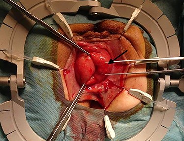 Adjusted surgical site using a Lonestar retractor. The rectal prolapse is exposed using Allis clamps. The tumor appears between three and six in lithotomy position (long arrow).