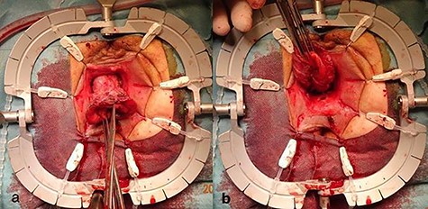 Incised rectal prolapse before circular dissection from the rectum. (a) Front view. (b) Rear view.
