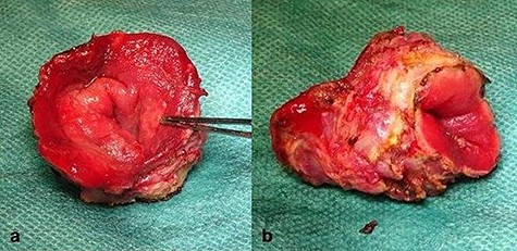 Completely resected tumor of rectum, 3.6-cm long and up to 3.0 cm in diameter. (a) Front view. (b) lateral view.