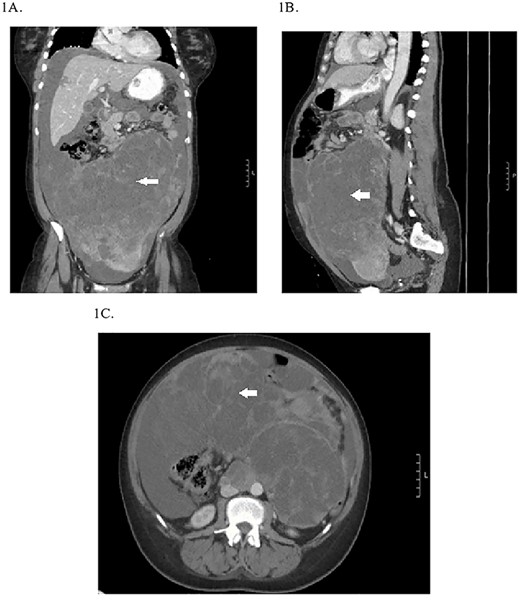 Preoperative CT abdomen/pelvis showing the pelvic tumor in coronal (A), sagittal (B) and transverse planes (C).
