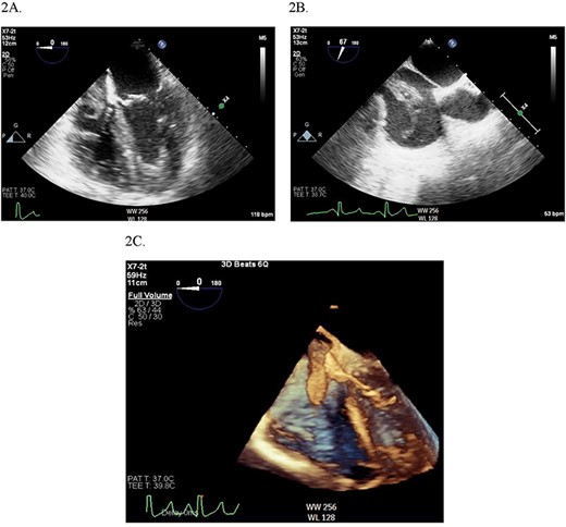 (A) Midesophageal four chamber TEE view showing large mobile mass of heterogeneous echogenicity in the RA. (B) Another view of the RA mass in a midesophageal bicaval view. (C) 3D illustration of the RA mass.