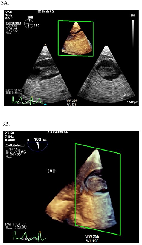 2D (A) and 3D (B) illustration of the IVC thrombus in long and short-axis views.