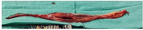 Intraoperative specimen of IVC tumor/thrombus that extends into the right atrium