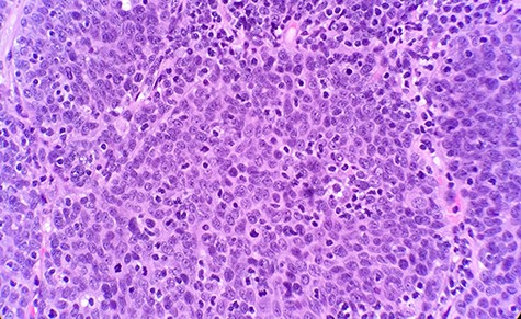 Microscopic examination reveals nest of small blue cells with high N/C ratio (HE ×40).
