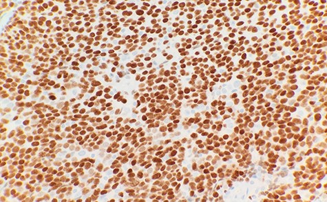 Tumor cells are immunopositive for p63 (IHC ×40).