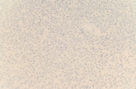 Tumor cells are immunonegative for chromogranin (IHC ×40).