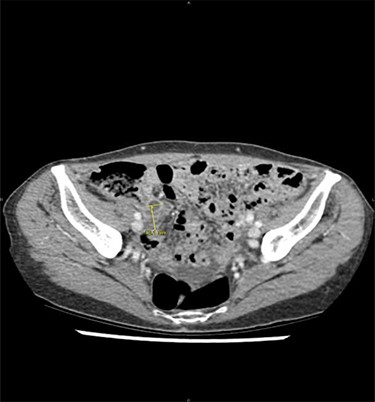 Acute appendicitis on abdominal computed tomodensitometry (yellow arrow), characterized hereby by a dilatation of the appendicular lumen (12 mm) with wall thickening.
