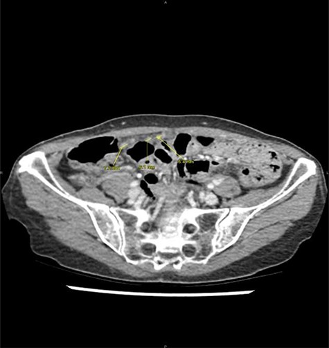 Peritoneal noduli observed after retrospective analysis of abdominal computed tomodensitometry (yellow arrow).