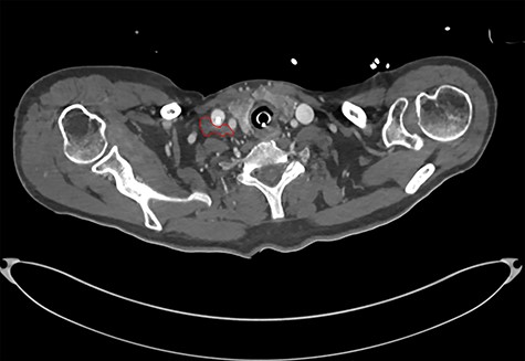 CT showing haematoma in the right carotid sheath following insertion of central line.