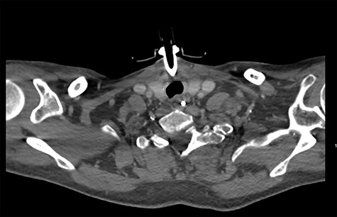 CT showing resolution of the haematoma.