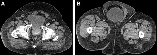 (A and B) Axial CT images of the abdomen and pelvis demonstrating the bladder herniating out of the inguinal canal into the scrotum.