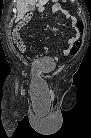 Coronal CT image of the abdomen and pelvis demonstrating herniation of the bladder through the inguinal canal into the scrotum, with associated oedema of the scrotal soft tissues.