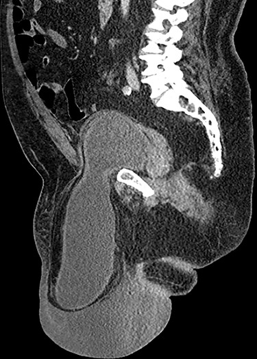 Sagittal CT image of the abdomen and pelvis demonstrating herniation of the bladder into the scrotum.