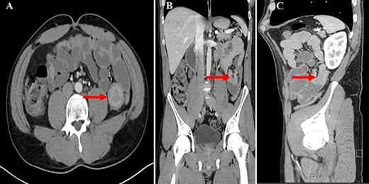 A. CT abdomen axial view showing the ‘Target Sign’ present within the small bowel; B. CT abdomen coronal view showing invagination of a proximal portion of small bowel into the adjacent section of bowel; C. CT abdomen sagittal view showing the aforementioned invagination of small bowel.