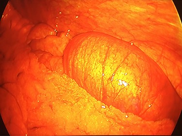 Intra-operative laparoscopic view of the intussuscepted small bowel prior to resection.