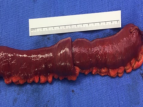 Gross resection specimen.