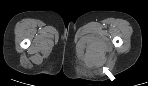 CT angiography axial slice demonstrating haematoma in posterior compartment of left thigh (white arrow).