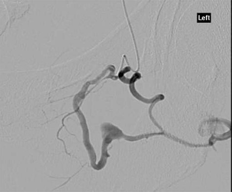 CT angiography with dye showing dilatation of collateral branch of left obturator artery.
