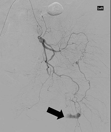 CT angiography showing extravasation of dye from muscular branch of the internal iliac artery (black arrow).