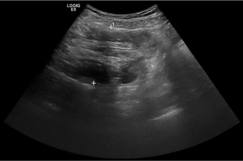 Abdominal ultrasound showed a ‘pseudokidney’ sign on the longitudinal view of the lower abdomen.
