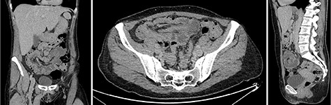 Intravenous contrast-enhanced abdominal and pelvic CT scan showed the full extent of the colocolic intussusception. No lead point was evident. (Left) Coronar view with ‘sausage’-shaped lesion. (Middle) Axial view with ‘sausage’-shaped lesion. (Right) Sagittal view with ‘targed’-shaped lesion.