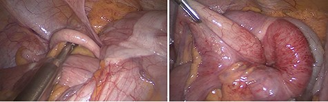 Intra-operative finding of the intussusception. (Left) The terminal ileum and the appendix were pulled like a tail by the intussusceptum into the intussusception. (Right) The cecum was identified as the intussusceptum, telescoping into the transverse colon that was identified as the intussuscipiens.