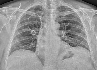 Postoperative X-ray after placement of TIVAD.