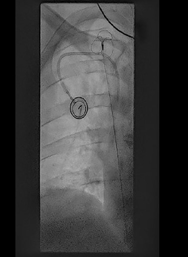 Perioperative fluoroscopy during removal of fibrin sheaths with a snare.