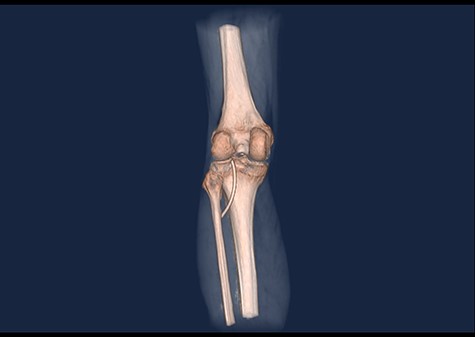 3D CT scan showing posteroanterior view with catheter embolus in the level of the left knee.