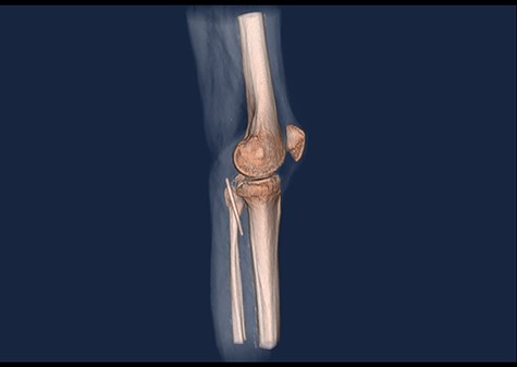 3D CT scan, lateral view.