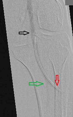 Perioperative contrast imaging showing the popliteal artery (black arrow) and the posterior tibial artery (green arrow) with the tip of the catheter embolus in the anterior tibial artery (red arrow).