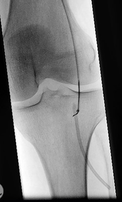 Perioperative image of percutaneous removal of the catheter using a snare.