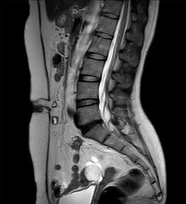 MRI sagittal view of the port site hernia.